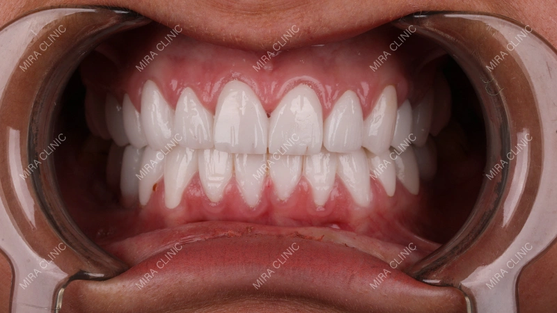 Dental Crowns as Part of Her Hollywood Smile